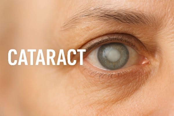 Cataract ke karan,lakshan or treatment.